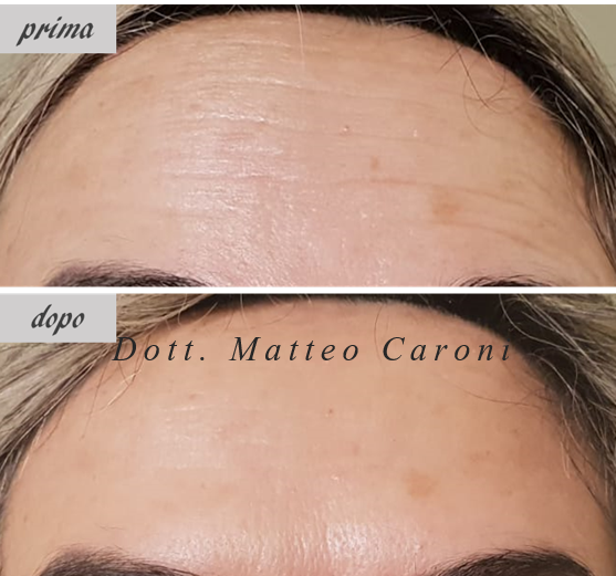 botox-fronte1_CARONI