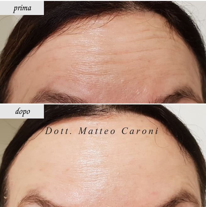 botox-fronte2_CARONI