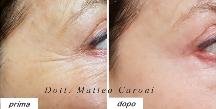 zampe-di-gallina_CARONI